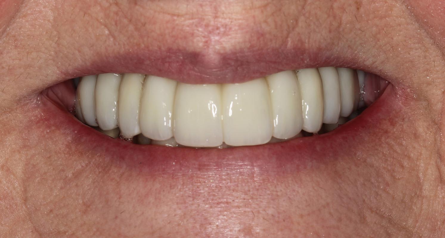 Full Arch/Full Mouth Implant Bridges After