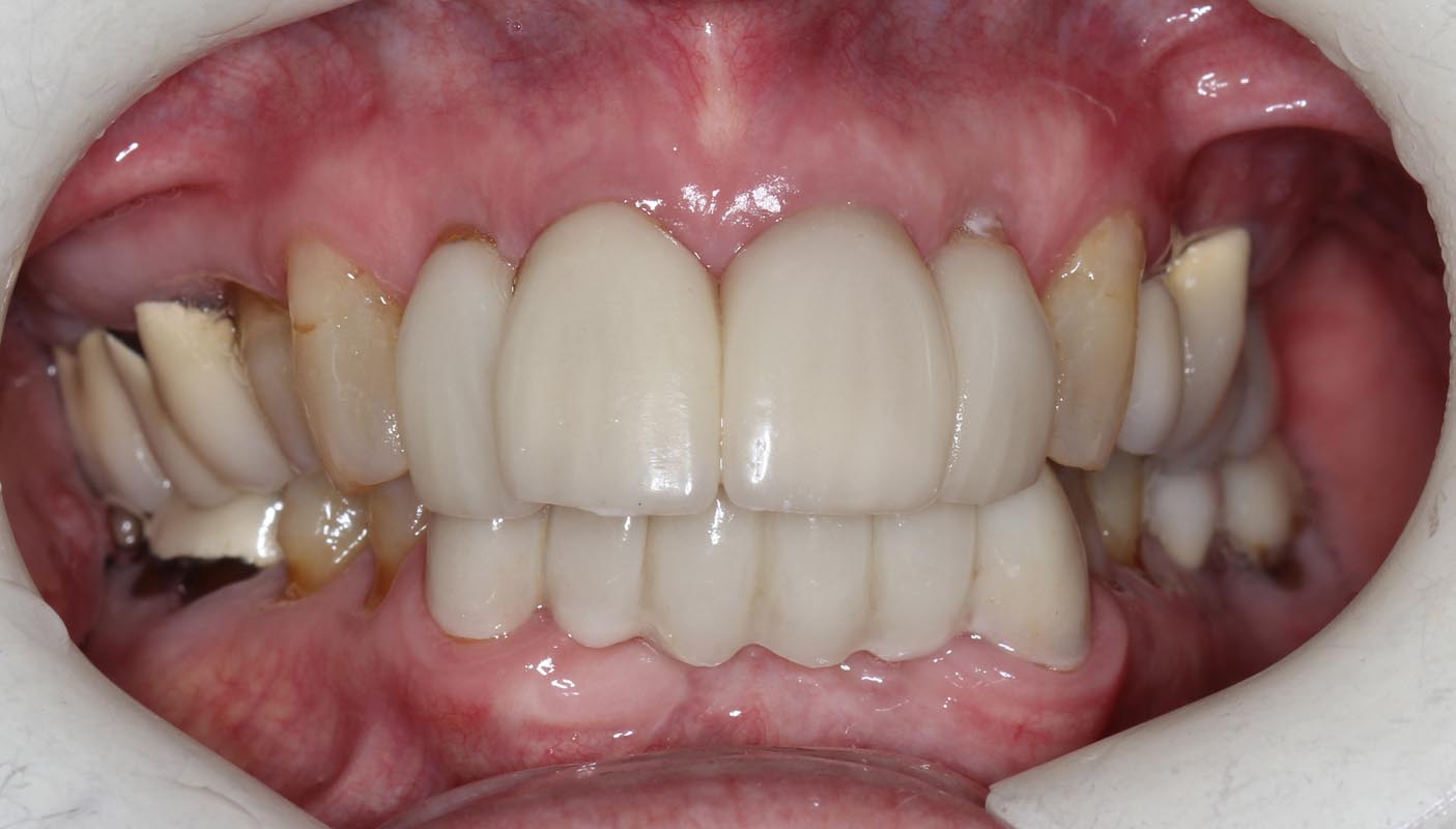 Full Arch/Full Mouth Implant Bridges Before