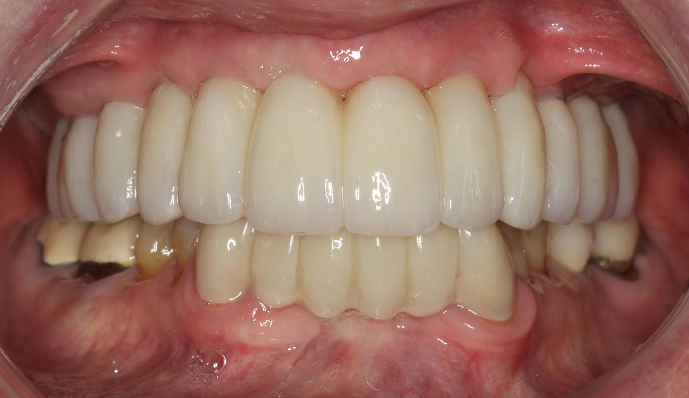 Full Arch/Full Mouth Implant Bridges After