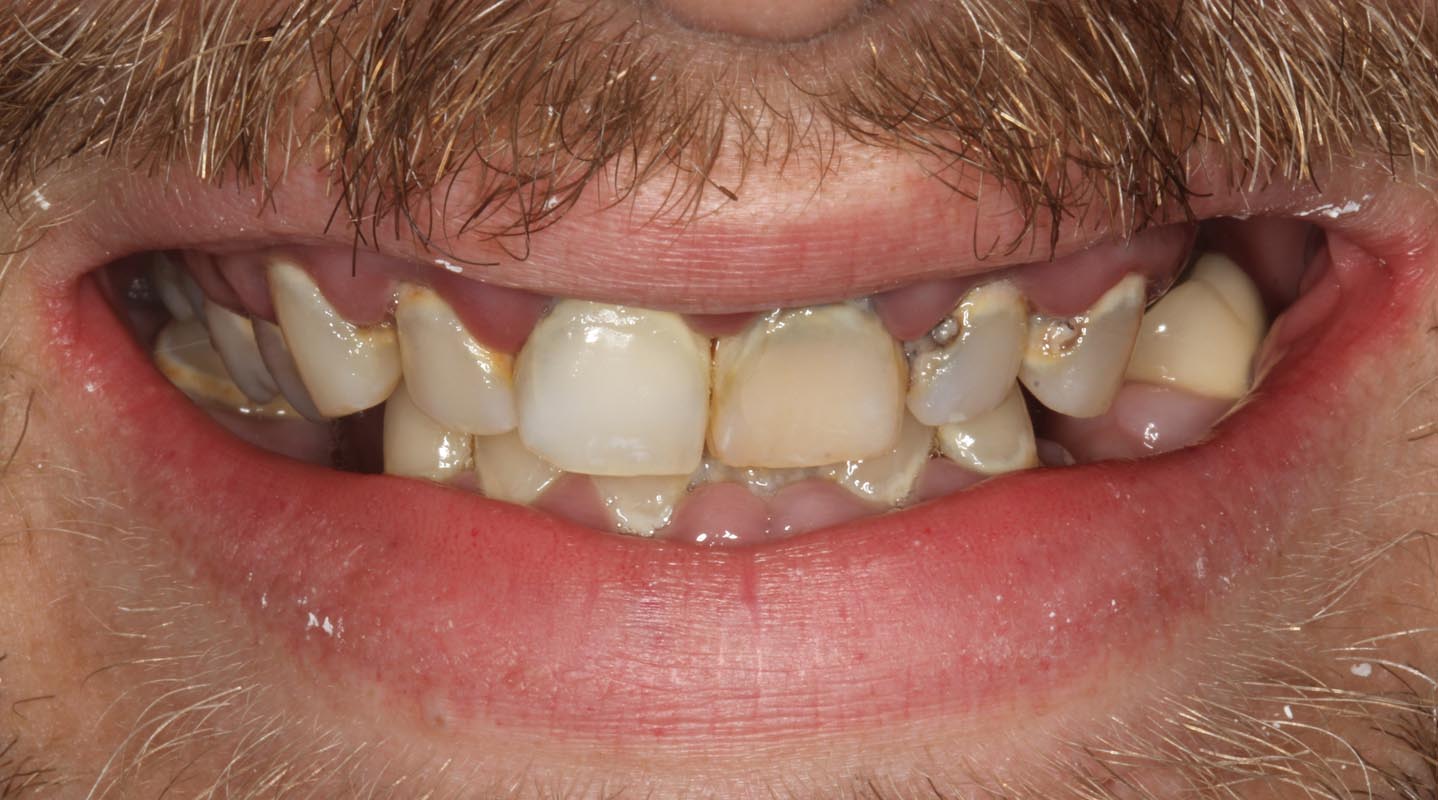 Full Arch/Full Mouth Implant Bridges Before