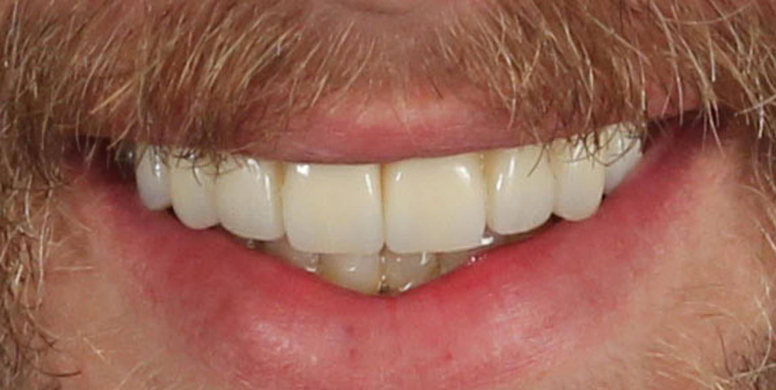 Full Arch/Full Mouth Implant Bridges After