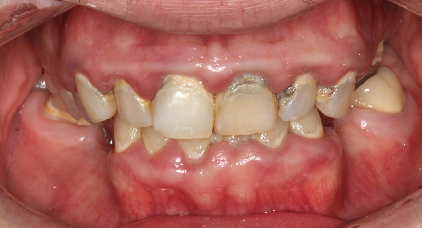 Full Arch/Full Mouth Implant Bridges Before