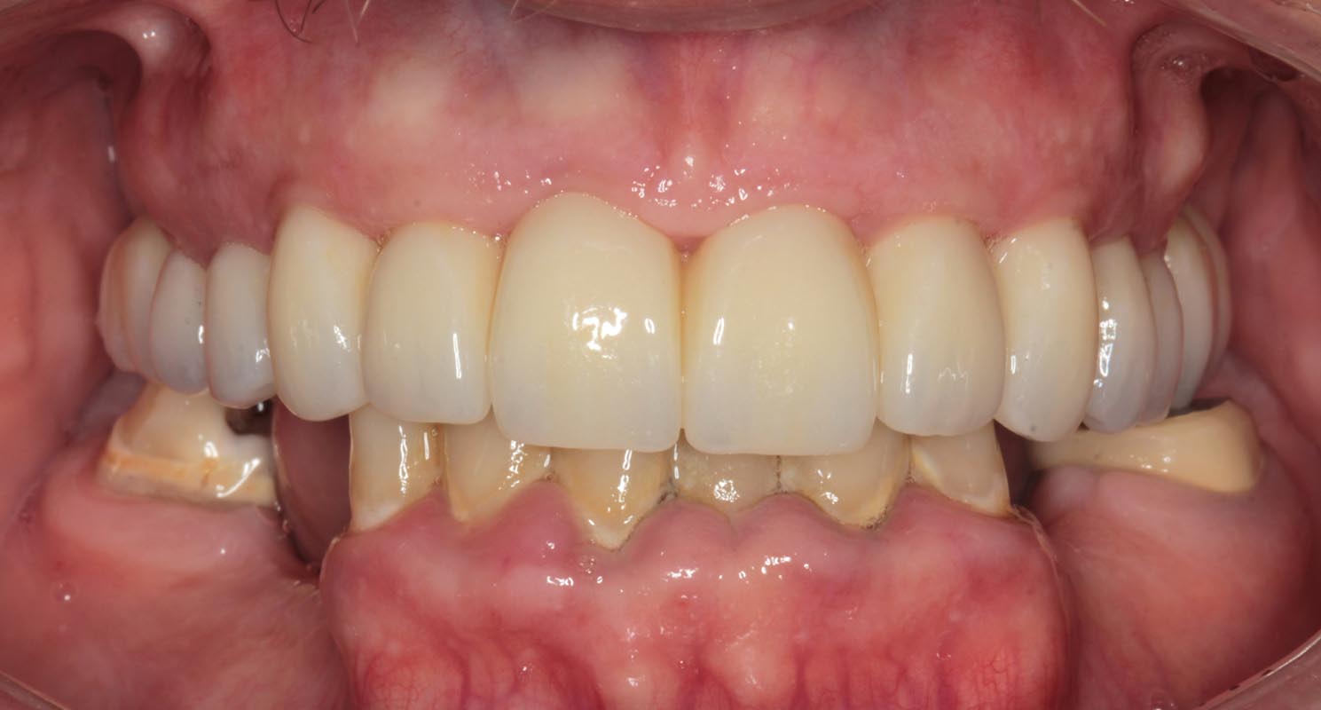 Full Arch/Full Mouth Implant Bridges After