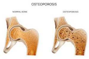 Osteoporosis5 (2)