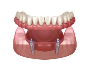 Mandibular replacement prosthesis All on 2 systems supported by implants with ball attachments