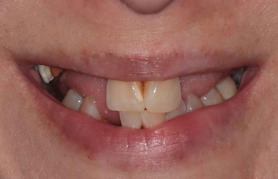 This patient came to our office dissatisfied with her smile. She a history of tooth decay/missing teeth and was looking to improve both her oral health and esthetics.