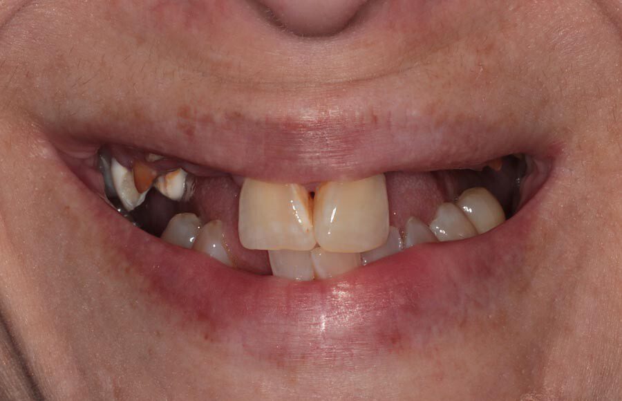 This patient came to our office dissatisfied with her smile. She a history of tooth decay/missing teeth and was looking to improve both her oral health and esthetics.