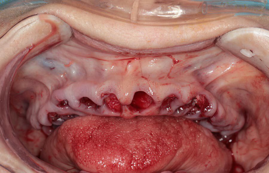 During the surgical appointment, all the teeth were extracted and implants were placed. The implants went in with sufficient torque/tightness so were able to make impressions and fabricate full-arch provisionals.