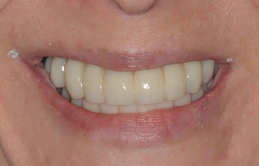 The patient travelled from another state for treatment so we only saw her again 3 months after surgery, when she was ready to start on the final prosthetic phase of treatment.