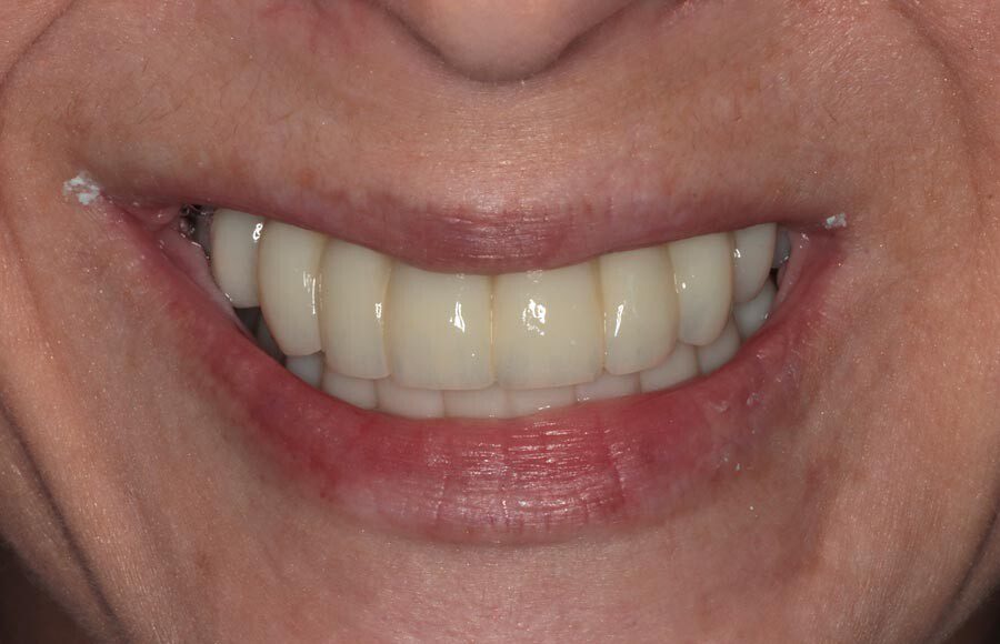 We use the provisionals at this stage as a starting point for designing definitive restorations. We assess them critically and discuss improvements that we would like to see. Tissues have also stabilized at this stage so the final restorations will be designed to compensate for any resorption that has taken place.
