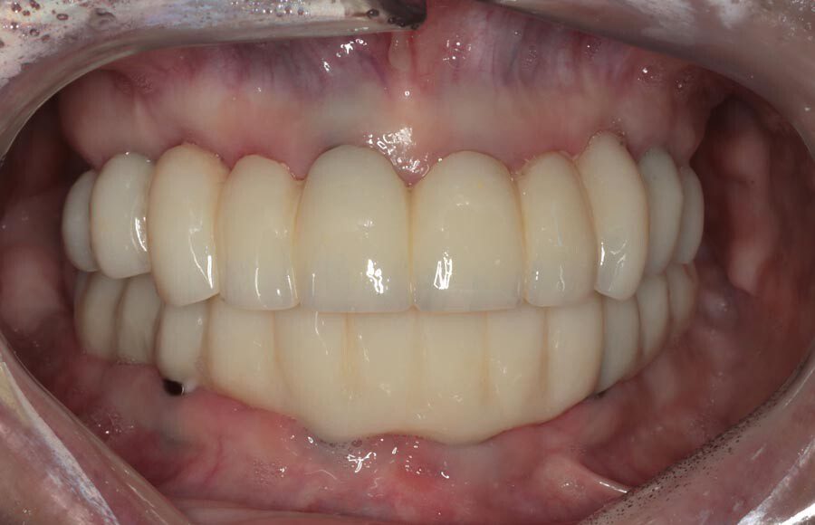 We use the provisionals at this stage as a starting point for designing definitive restorations. We assess them critically and discuss improvements that we would like to see. Tissues have also stabilized at this stage so the final restorations will be designed to compensate for any resorption that has taken place.