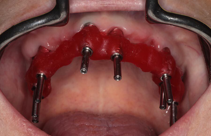 Splinted impressions are made for maximum accuracy at this stage. Records are completed and sent to our partner lab so they can start creating wax prototypes for us to test.