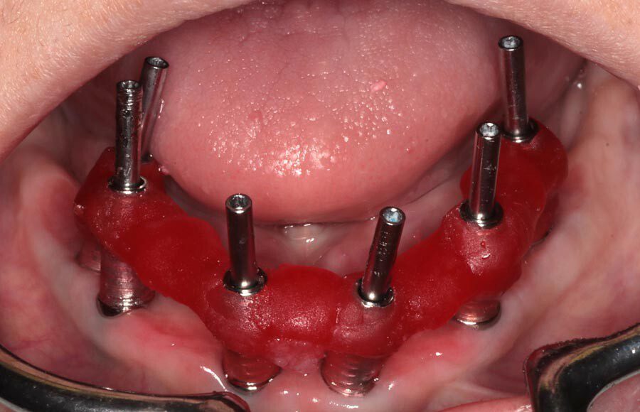 Splinted impressions are made for maximum accuracy at this stage. Records are completed and sent to our partner lab so they can start creating wax prototypes for us to test.