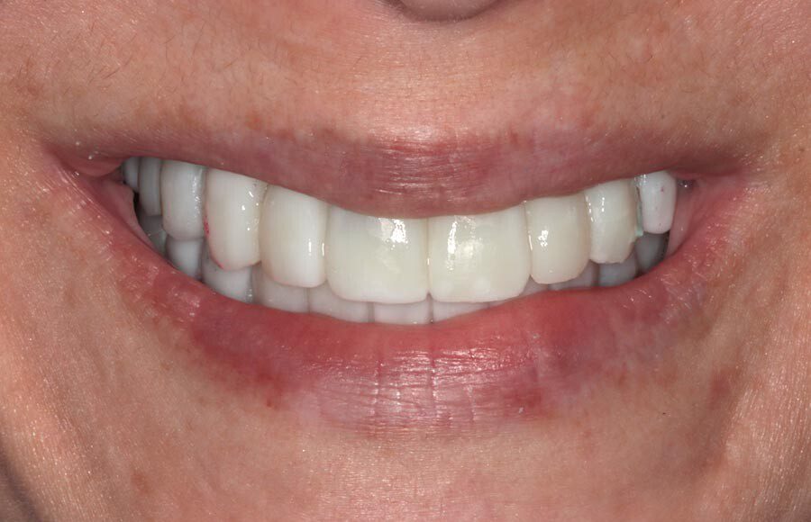 The prototypes are tested in the mouth to ensure we all love the size, shape, and position of the teeth.