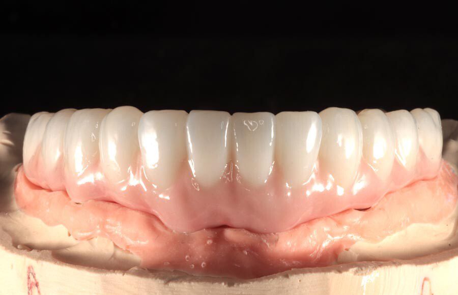 Once the final design is approved, the lab begins fabricating definitive restorations. They are able to add a lot more character and definition at this stage, resulting in restorations that are beautiful and realistic.