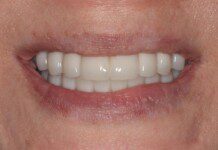 Full Mouth Implant Treatment The patient couldn’t be happier with her new smile. We have improved not only her esthetics but her oral health as well. She now has beautiful restorations she can keep for years to come. Contact us if you would like to have a consultation and see if this is the right treatment for you!