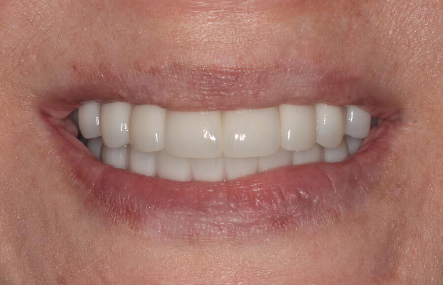 The patient couldn&rsquo;t be happier with her new smile. We have improved not only her esthetics but her oral health as well. She now has beautiful restorations she can keep for years to come. Contact us if you would like to have a consultation and see if this is the right treatment for you!