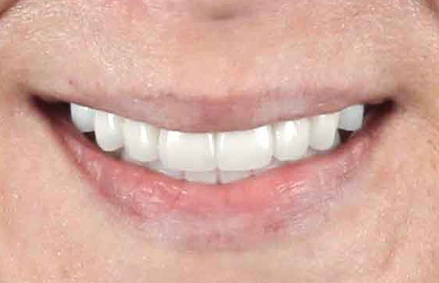 The patient couldn&rsquo;t be happier with her new smile. We have improved not only her esthetics but her oral health as well. She now has beautiful restorations she can keep for years to come. Contact us if you would like to have a consultation and see if this is the right treatment for you!