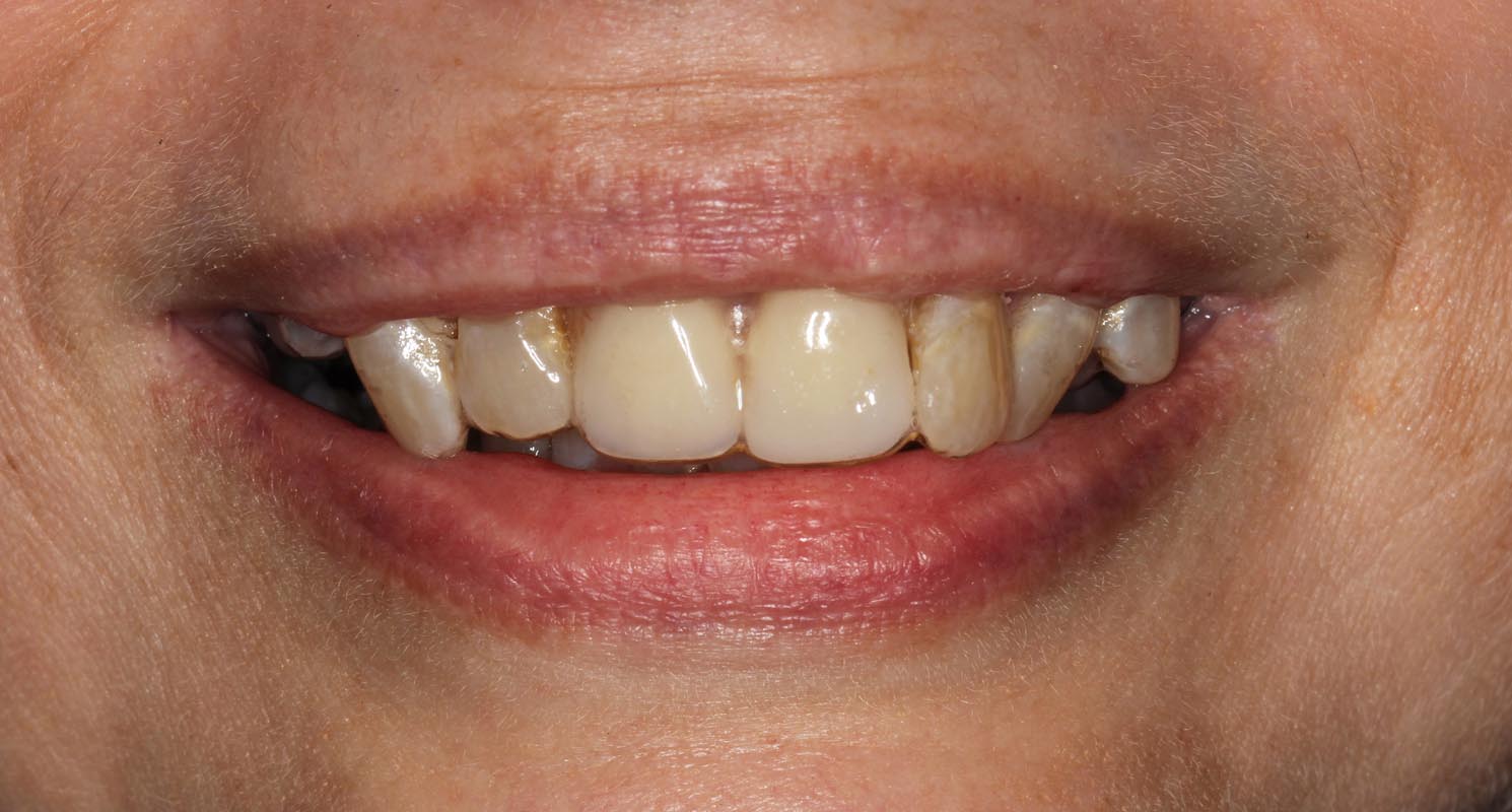 Full Arch/Full Mouth Implant Bridges Before