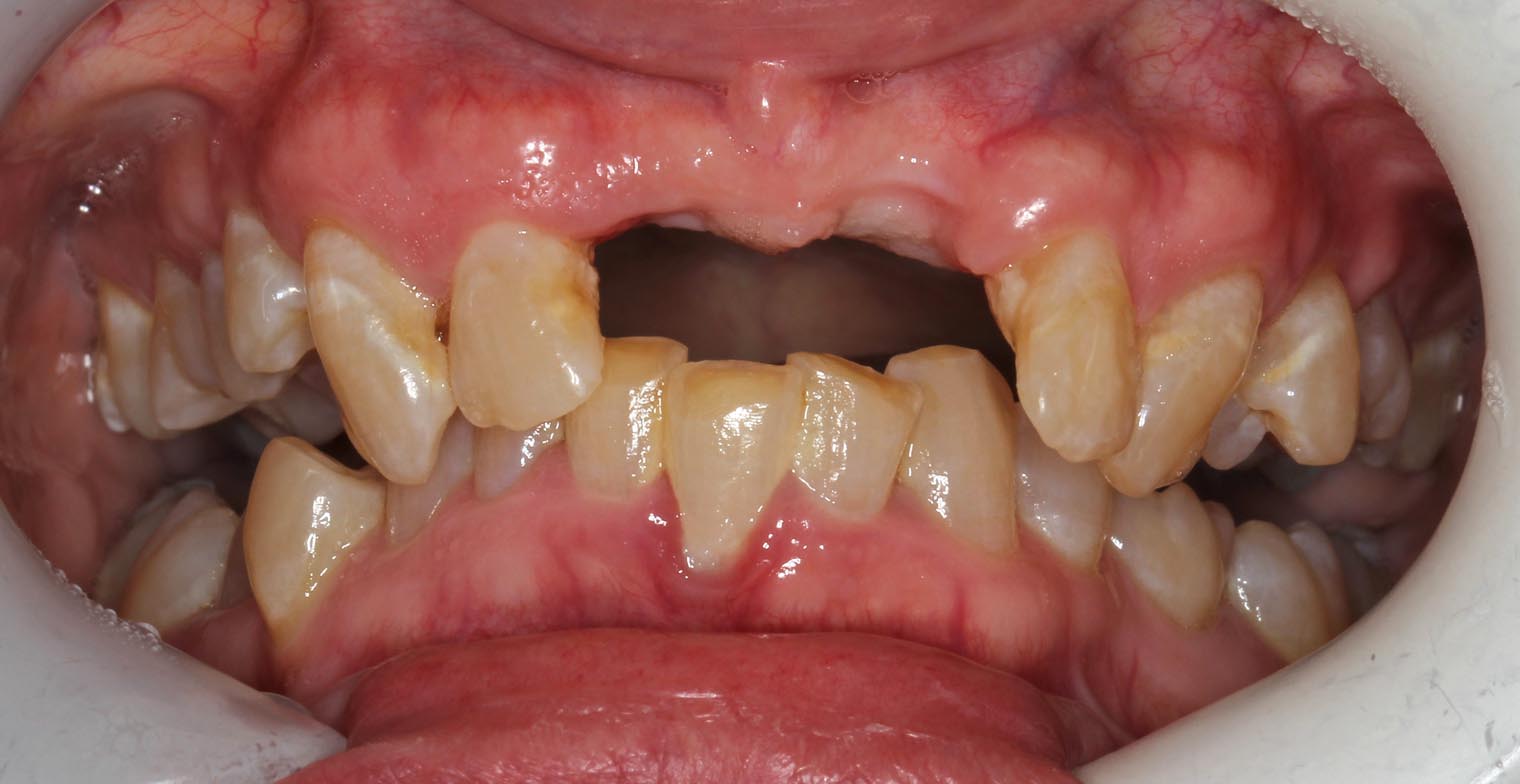 Full Arch/Full Mouth Implant Bridges Before