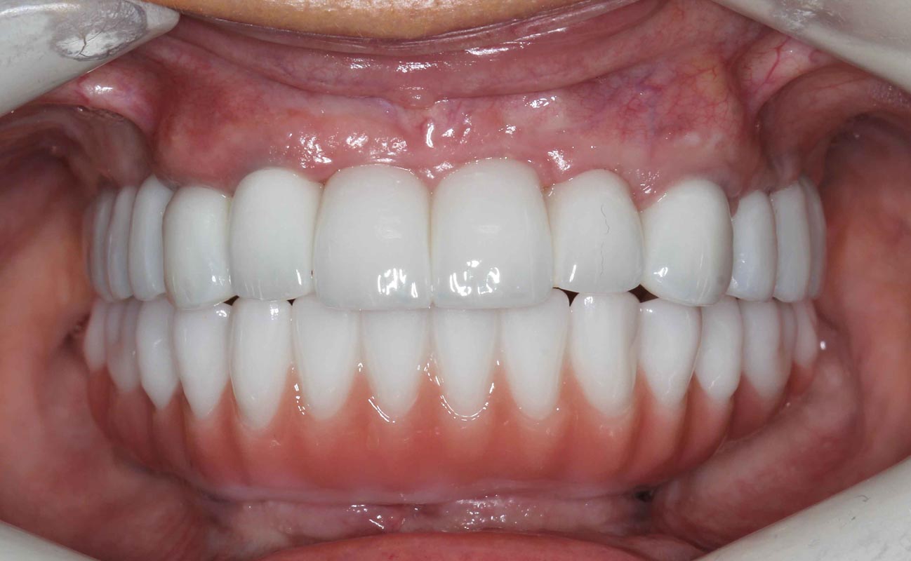 Full Arch/Full Mouth Implant Bridges After