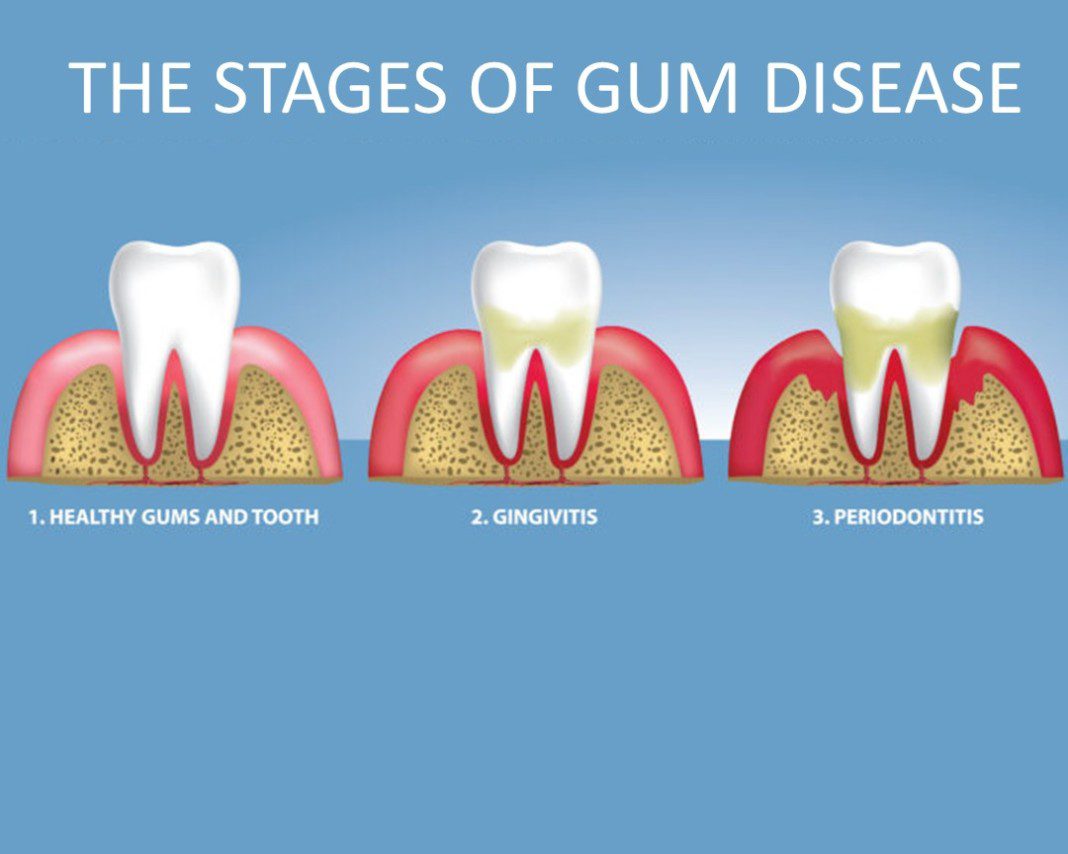 Gingivitis And Periodontal Disease Dental Implant Center