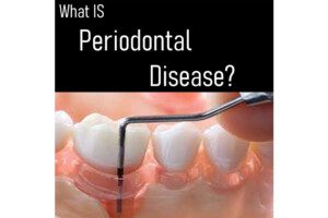 Perio_What-Is_03
