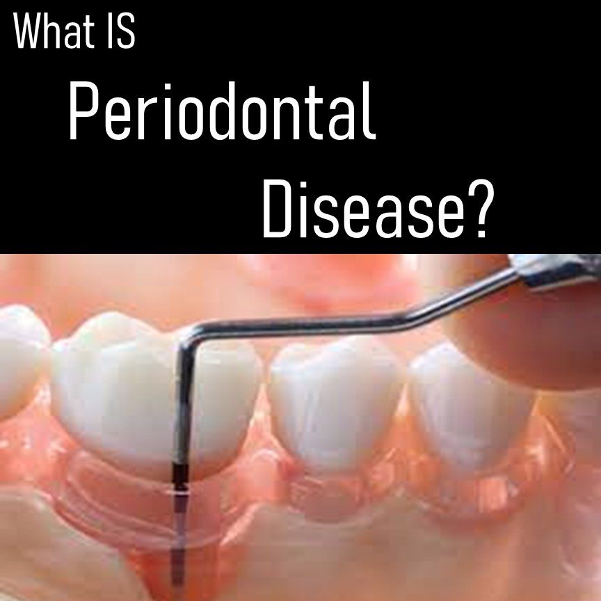 All About Periodontal Disease Dental Implant Center