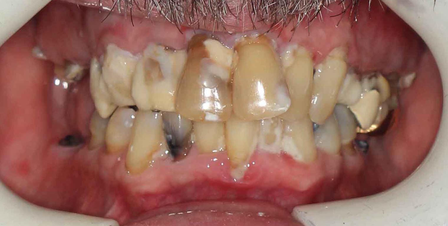 Full Arch/Full Mouth Implant Bridges Before