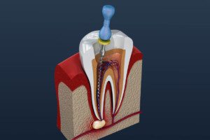 "Top causes of tooth breakage, root canals being done without crowns to protect teeth"