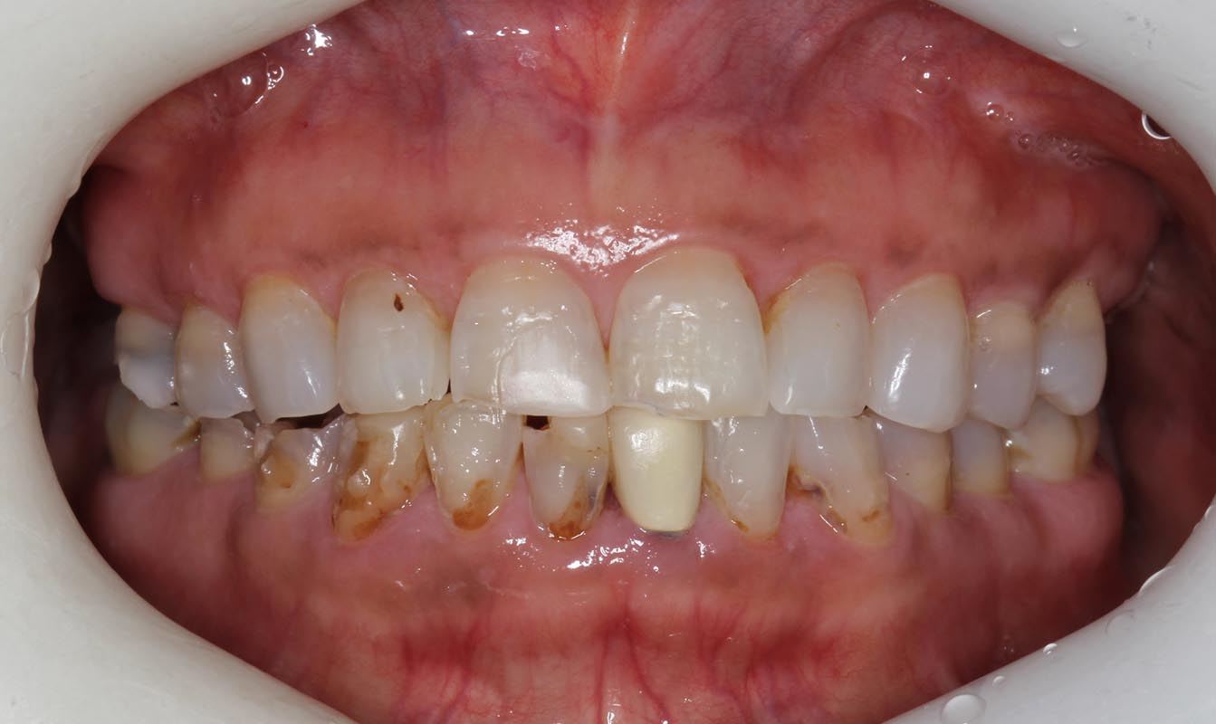 Full Arch/Full Mouth Implant Bridges Before