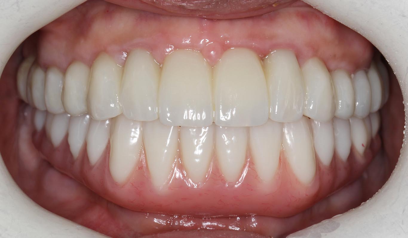 Full Arch/Full Mouth Implant Bridges After