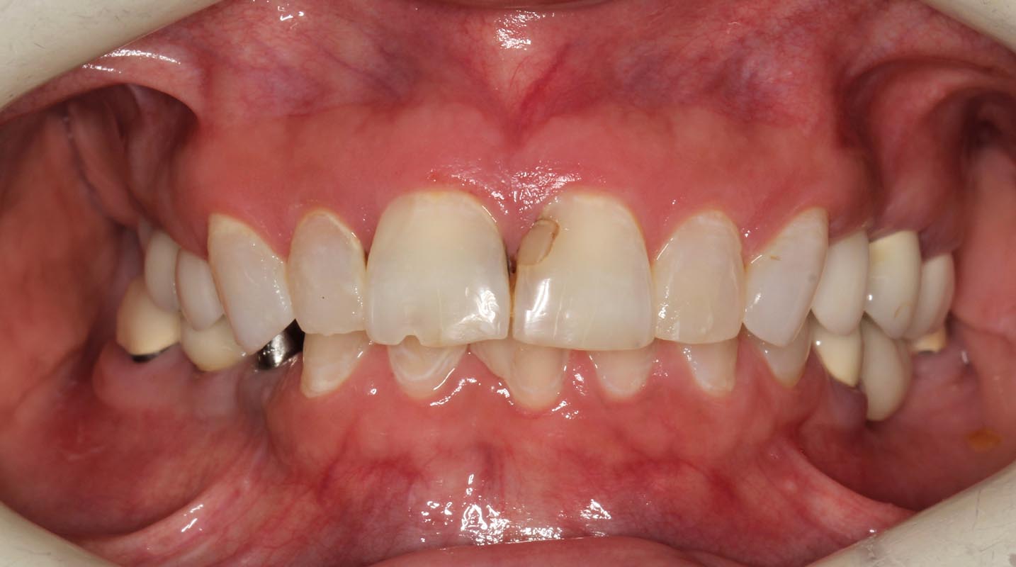 Full Arch/Full Mouth Implant Bridges Before