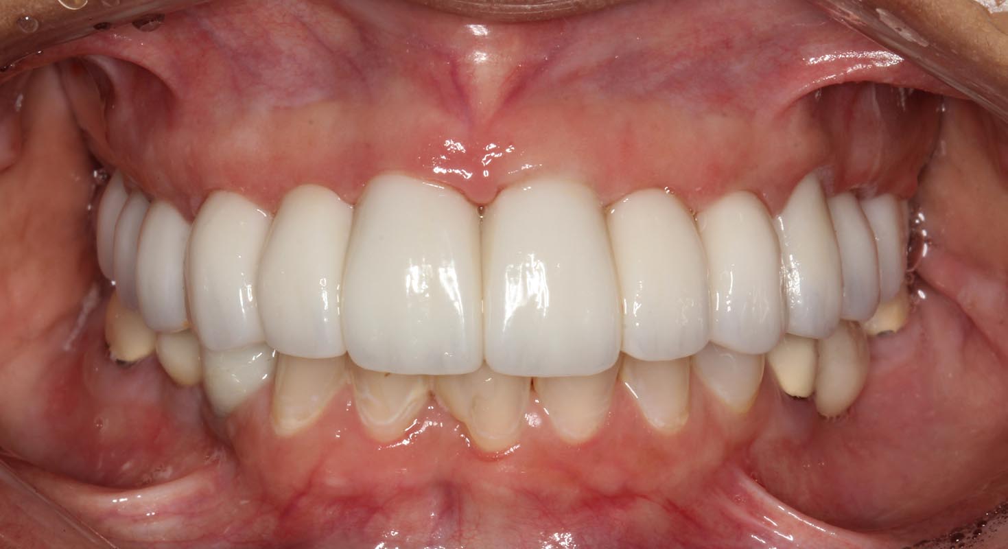 Full Arch/Full Mouth Implant Bridges After