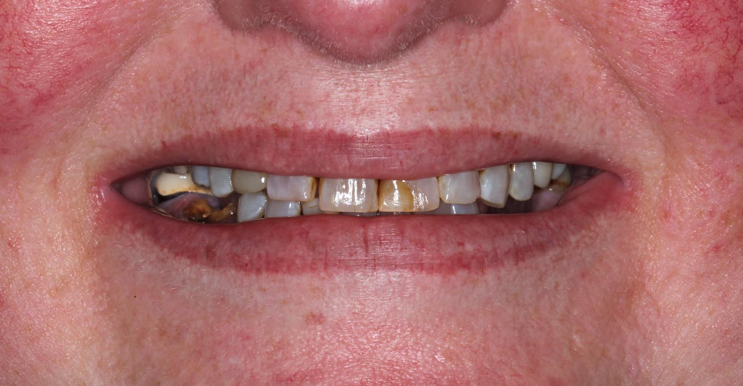 Full Arch/Full Mouth Implant Bridges Before