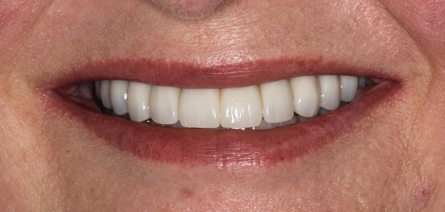 Full Arch/Full Mouth Implant Bridges After