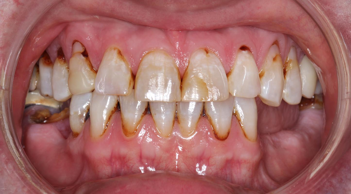 Full Arch/Full Mouth Implant Bridges Before