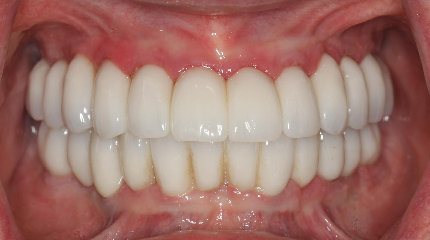 Full Arch/Full Mouth Implant Bridges After