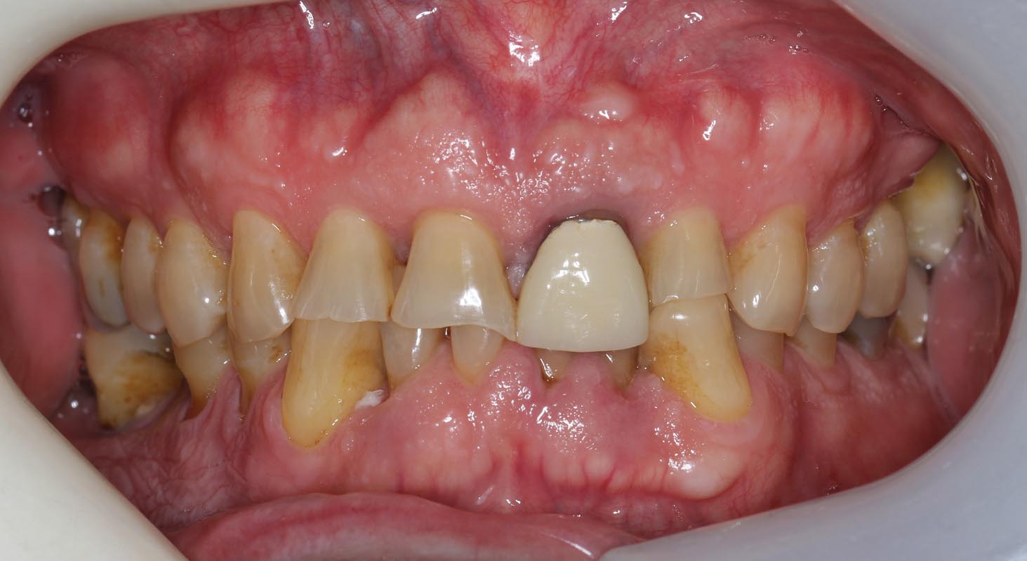 Full Arch/Full Mouth Implant Bridges Before