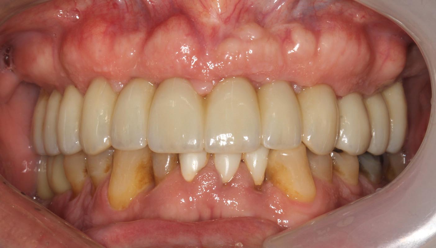 Full Arch/Full Mouth Implant Bridges After