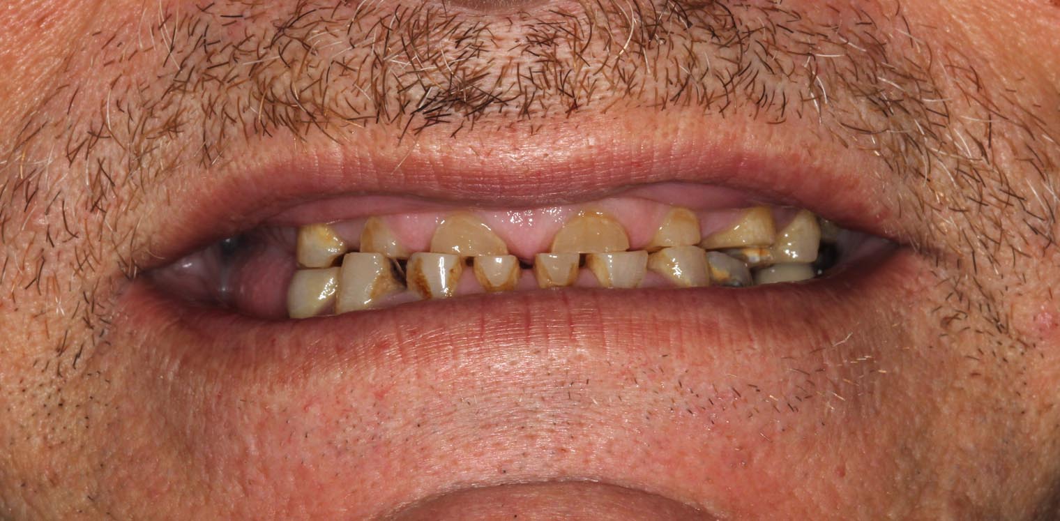 Full Arch/Full Mouth Implant Bridges Before