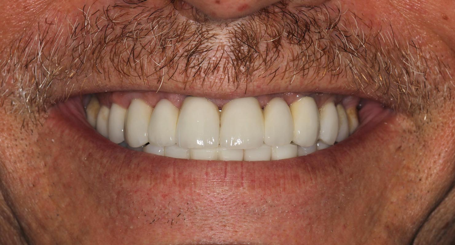 Full Arch/Full Mouth Implant Bridges After