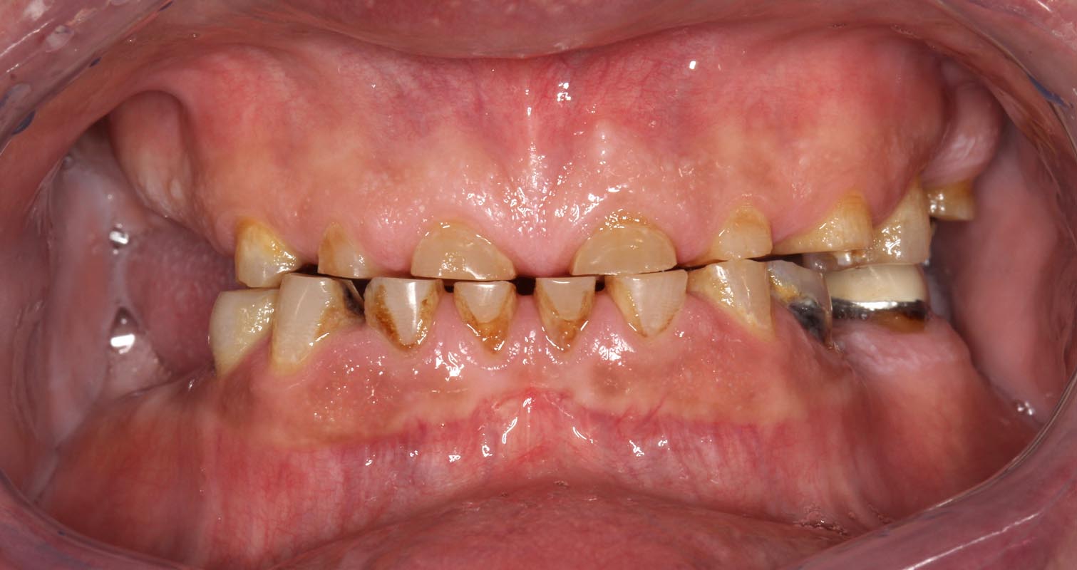 Full Arch/Full Mouth Implant Bridges Before