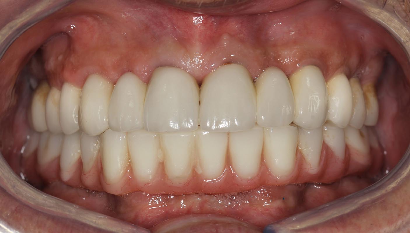 Full Arch/Full Mouth Implant Bridges After