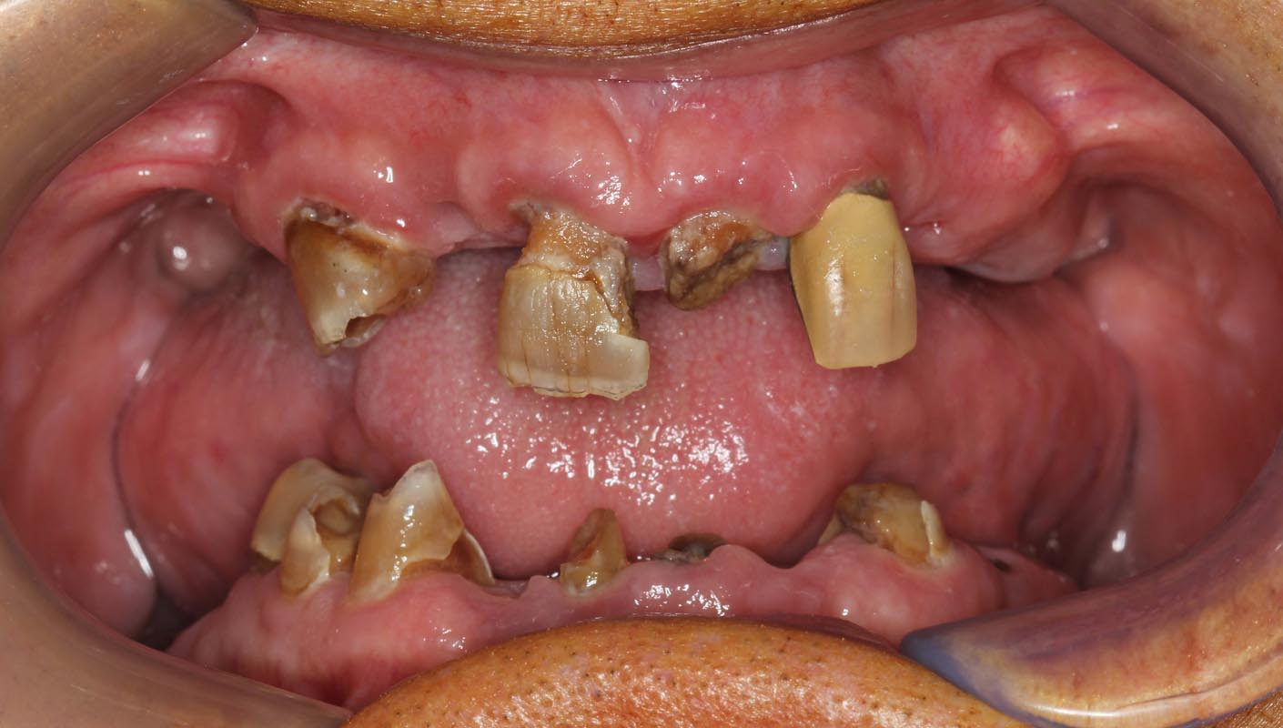 Full Arch/Full Mouth Implant Bridges Before