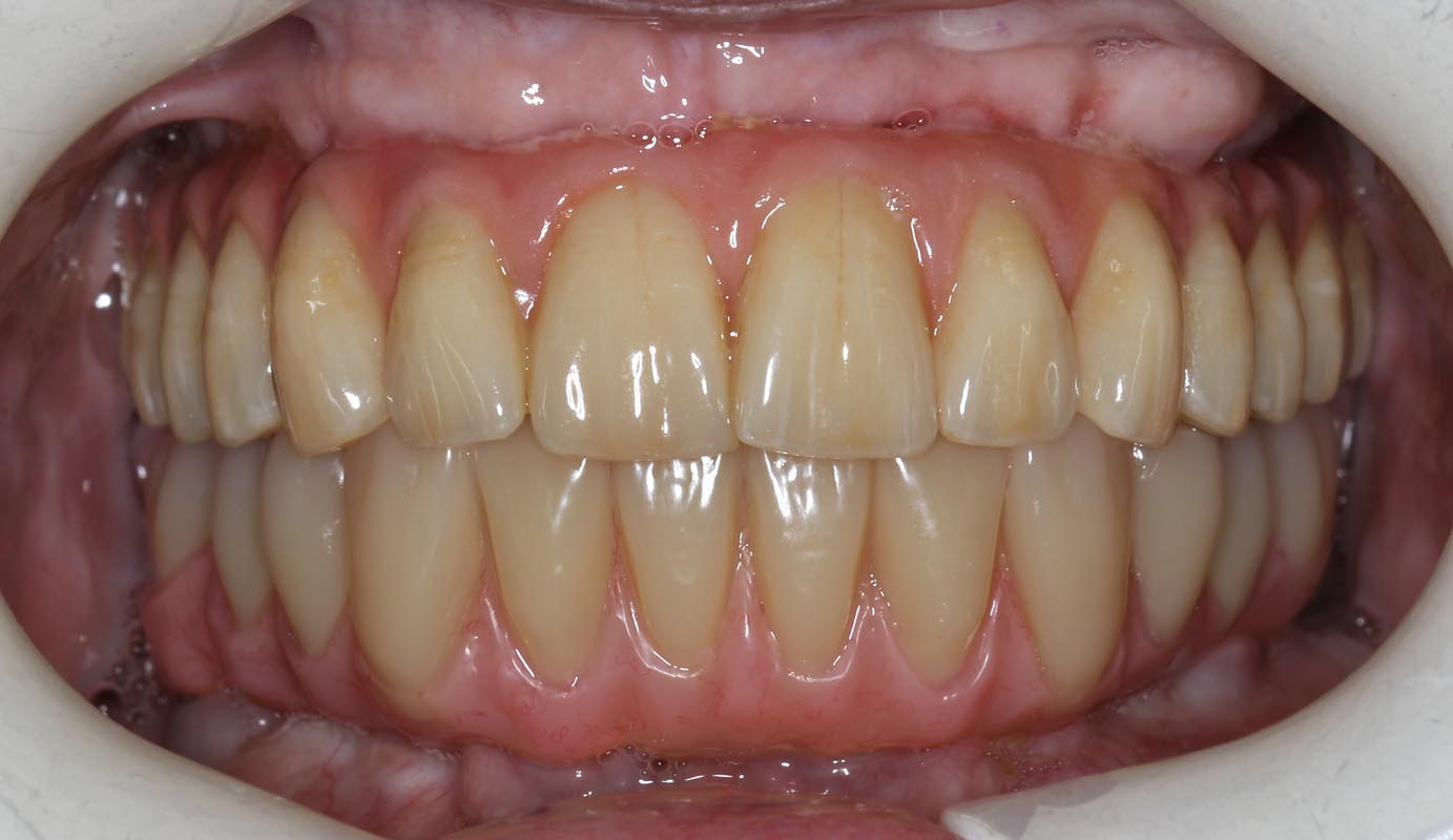 Full Arch/Full Mouth Implant Bridges After