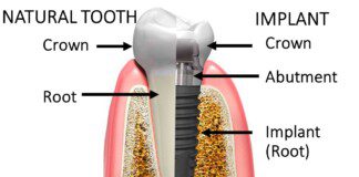 diagram of parts of a tooth implant
