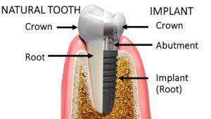 cross section of a real tooth and an implant