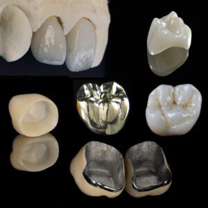 Types of dental crowns