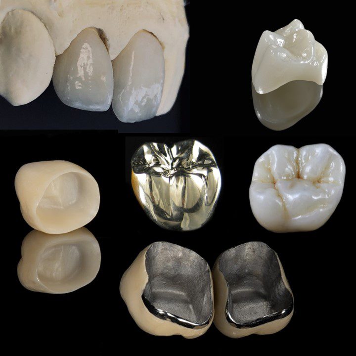 how-much-do-crowns-cost-dental-implant-center